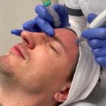 Microneedling